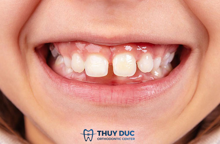 Một số tình trạng răng miệng thường gặp ở trẻ 3