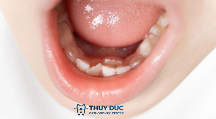 Một số tình trạng răng miệng thường gặp ở trẻ 1