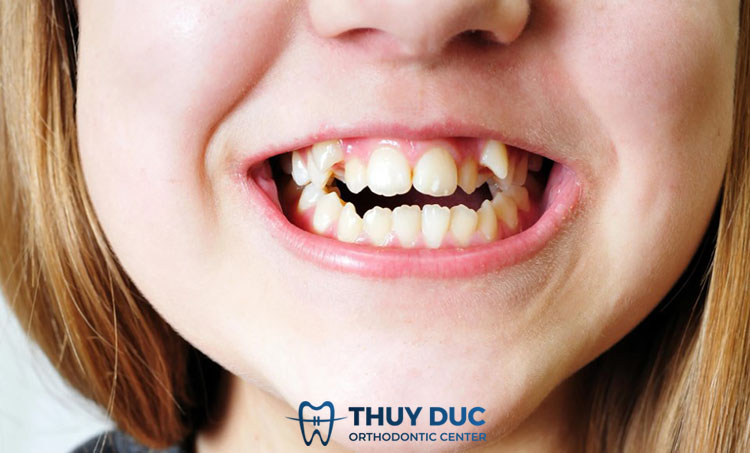 Răng mọc sai lệch/hô, móm, chen chúc 1
