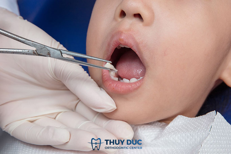 Tầm quan trọng của việc nhổ răng sữa đúng thời điểm 1