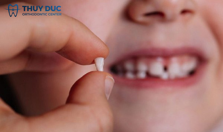 Tìm hiểu mốc thời gian thay răng sữa ở trẻ 1