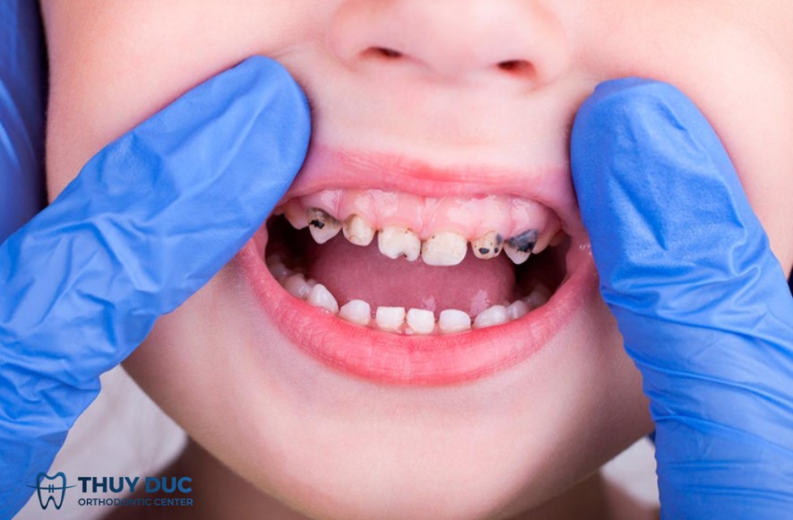 1. Siết răng răng ở trẻ em là gì? 1