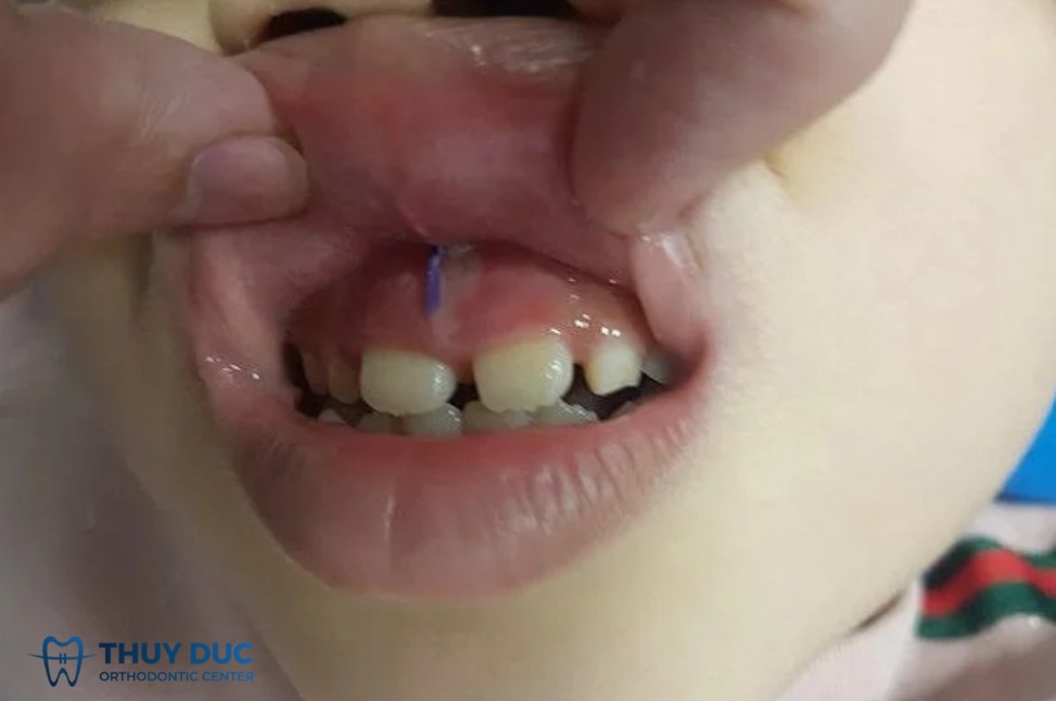 2.4. Các phương pháp điều trị răng cửa bị hở 1