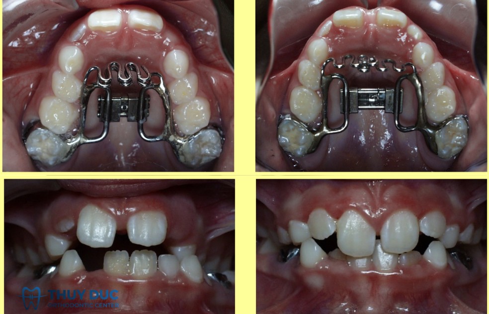 2.4. Các phương pháp điều trị răng cửa bị hở 2 2.4. Các phương pháp điều trị răng cửa bị hở 2