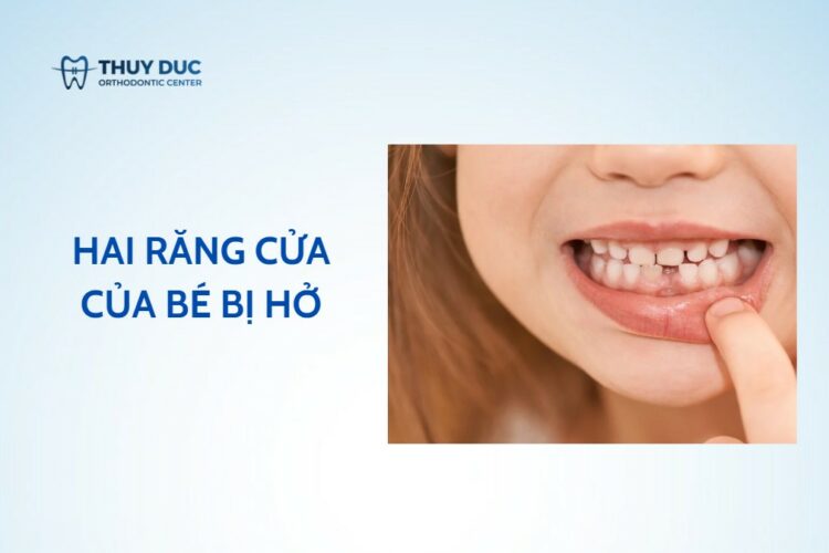 Hai răng cửa của bé bị hở – điều cha mẹ cần quan tâm