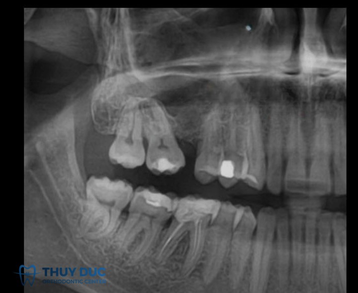 1. Răng bị nghiêng, đổ vào khoảng trống mất răng 1