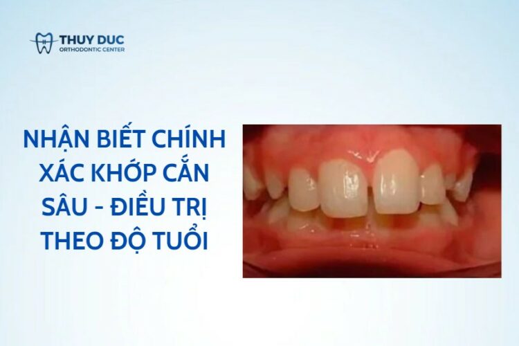 Nhận biết chính xác khớp cắn sâu – điều trị theo độ tuổi