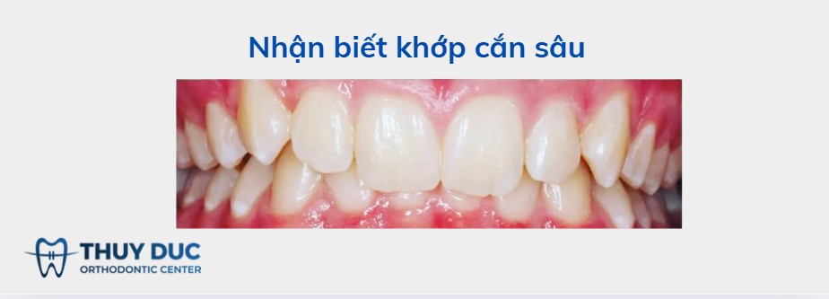 Thế nào là khớp cắn sâu? 1