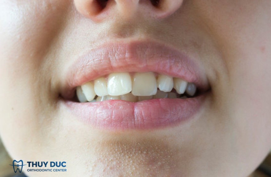 6. Phục hình thẩm mỹ vùng răng cửa nhưng không muốn mài nhiều mô răng 1