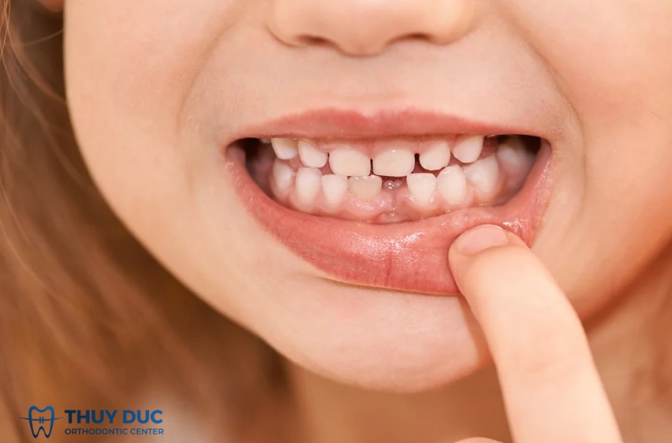 2.1. Các nguyên nhân phổ biến khiến răng cửa vĩnh viễn bị hở 1