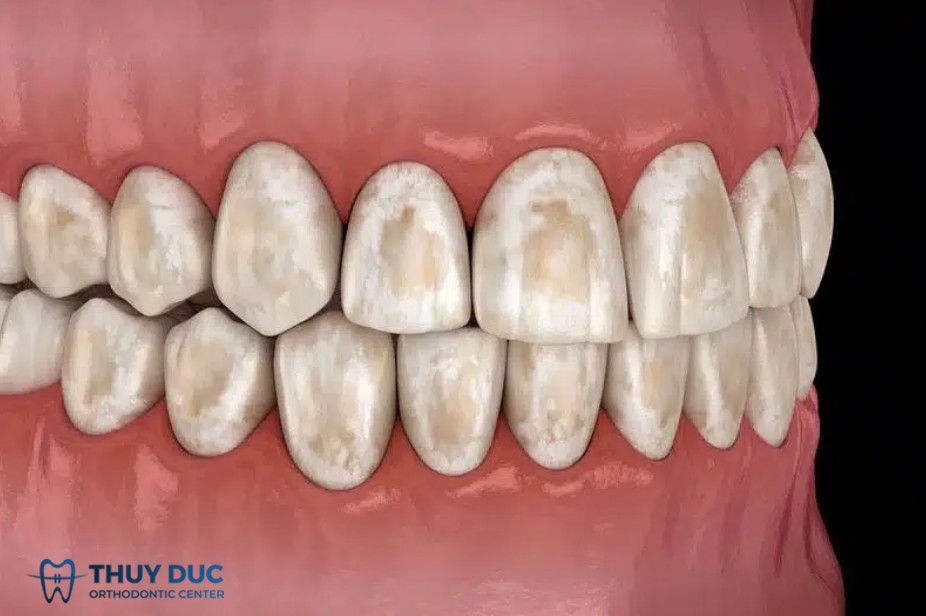 1.2. Nhiễm fluor quá mức (Fluorosis) 1