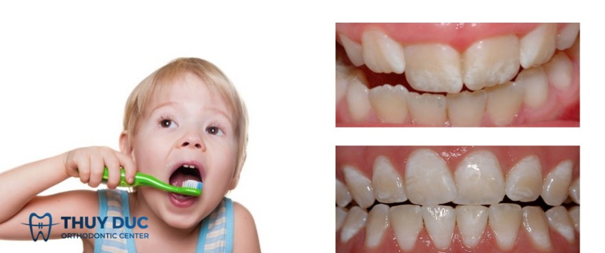 5. Nhiễm Fluoride (Fluorosis) 1