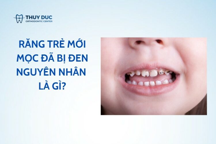 Răng trẻ mới mọc đã bị đen – xem ngay nguyên nhân là gì