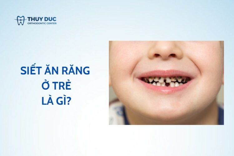 Răng trẻ em bị siết – siết ăn răng ở trẻ em là gì?