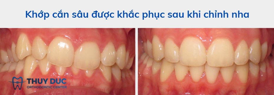 Các ảnh hưởng của khớp cắn sâu: Không chỉ là vấn đề thẩm mỹ 1