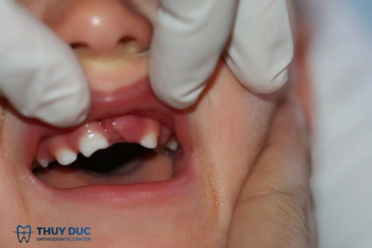 Bé 3 tuổi bị sưng nướu răng – liệu có phải chỉ là viêm lợi thông thường?