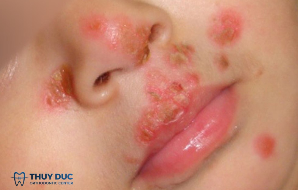 1.1 Viêm niêm mạc miệng do virus 1