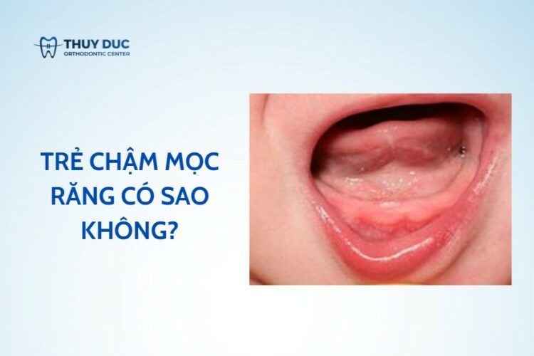 Trẻ mọc răng chậm có phải là chậm lớn, khi nào cần lo?