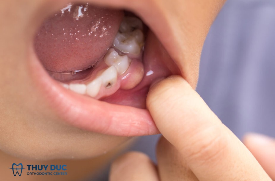 3.2. Sưng nướu có mủ - dấu hiệu nhiễm trùng 1