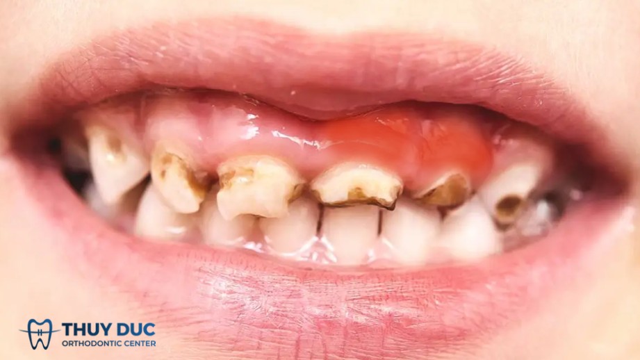 4.2. Diễn biến nặng nếu không được can thiệp sớm 1