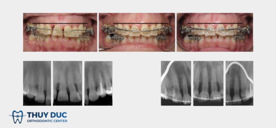 5.1 Dùng mắc cài và dây cung chỉnh nha 1