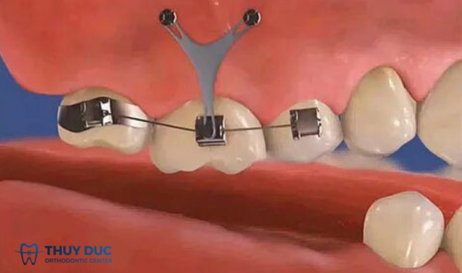5.2 Dùng minivis (mini-implants) 1