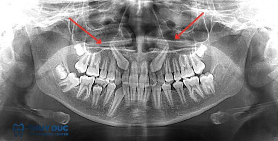 1. Khái niệm răng mọc ngầm 1