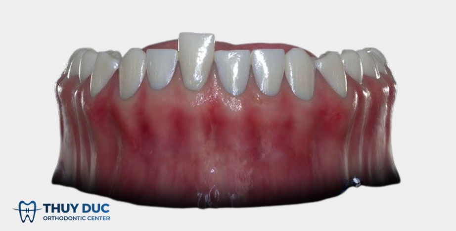 2. Vì sao kỹ thuật này quan trọng trong chỉnh nha? 1