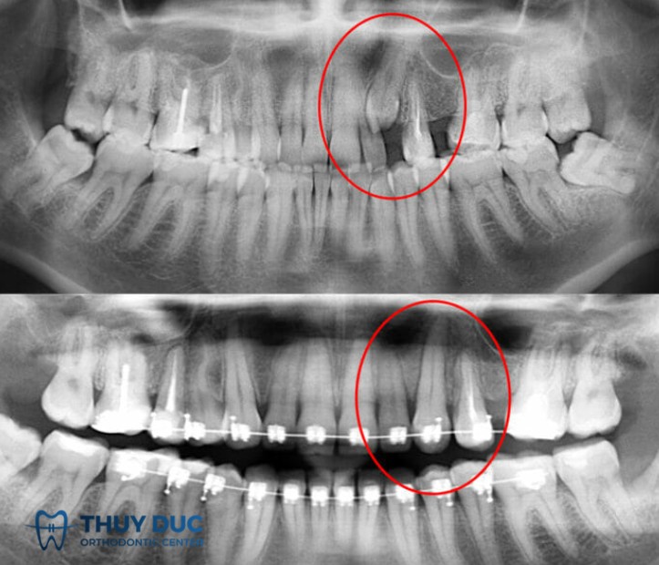 4.2 Kéo răng mọc ngầm bằng khí cụ chỉnh nha 1