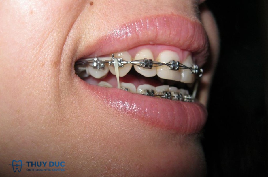 3. Siết chỉnh răng có thể làm tổn thương dây thần kinh không? 1