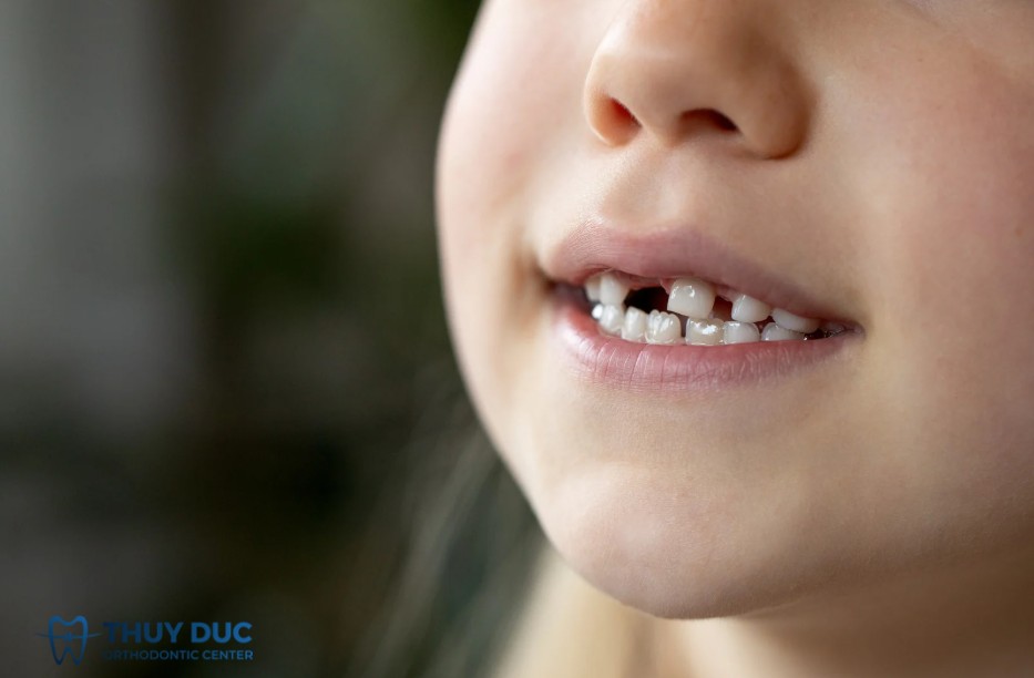1. Thay răng sữa ở 5 tuổi: bình thường hay bất thường? 1