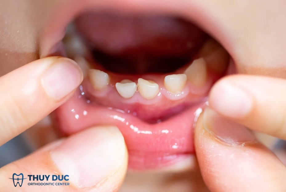2. Dấu hiệu nhận biết bé sắp thay răng 1