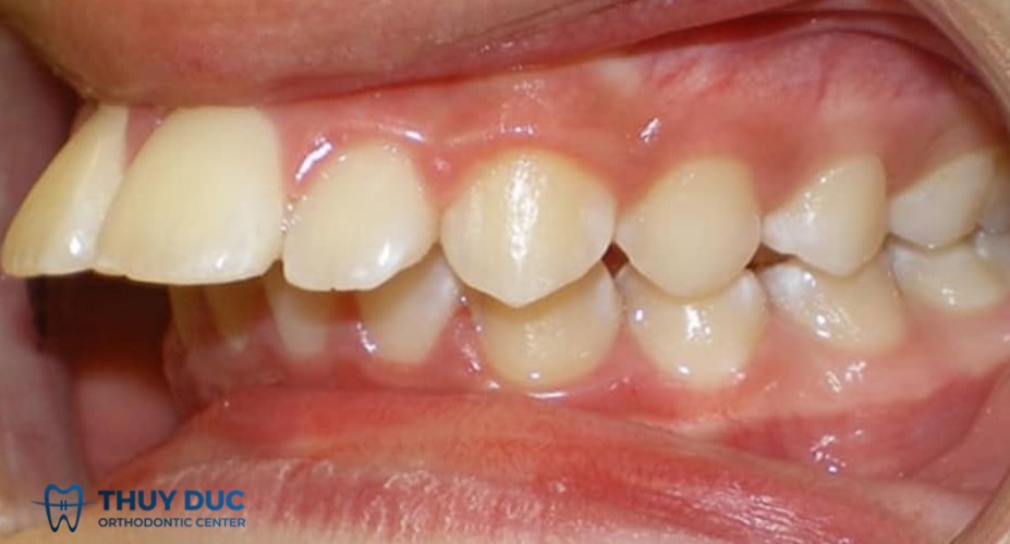 1. Những biến dạng răng, hàm thường gặp 1