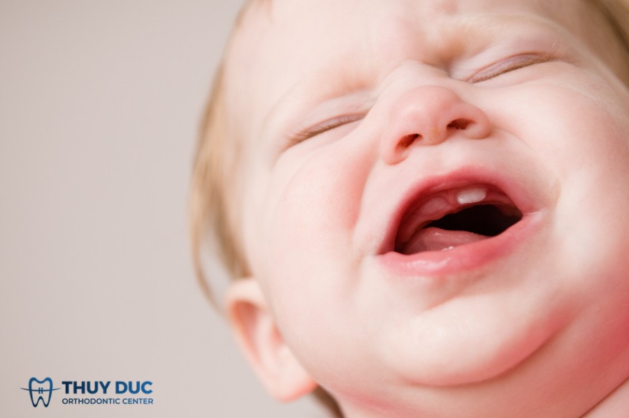 1. Bé mọc 1 răng là nghịch ngợm phải không? 1
