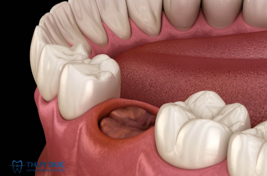 Ổ răng khô 1 Ổ răng khô 1