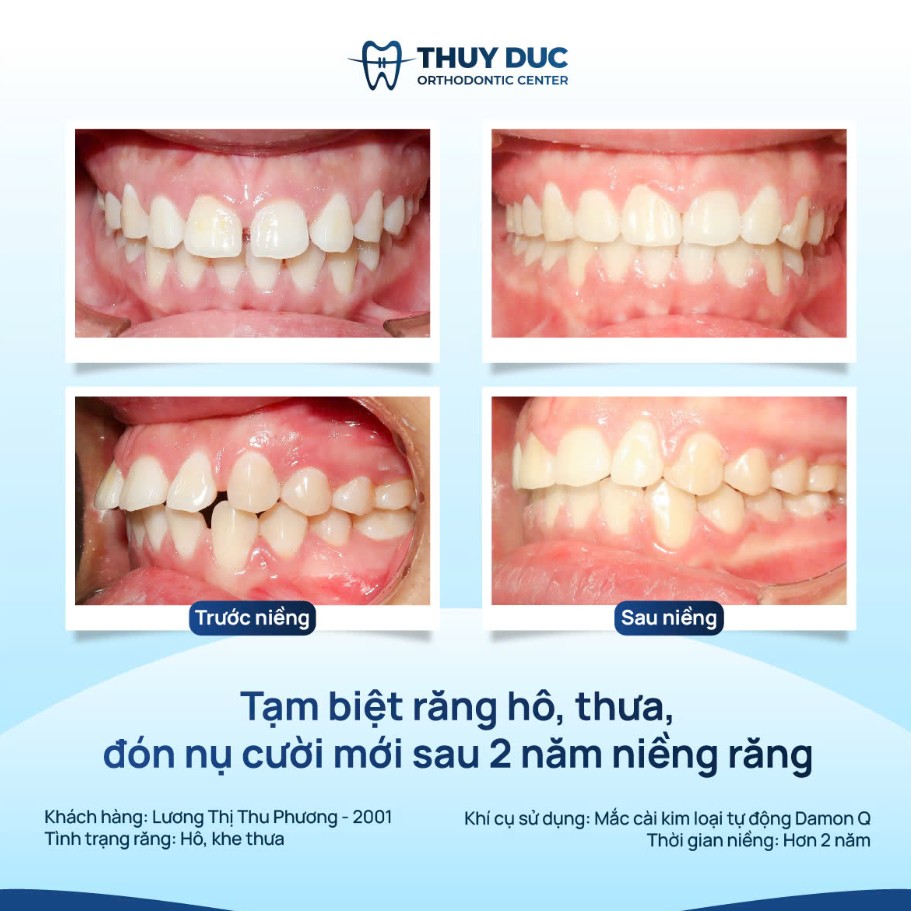 5. Hình ảnh một số ca niềng răng thưa tại nha khoa Thúy Đức 1