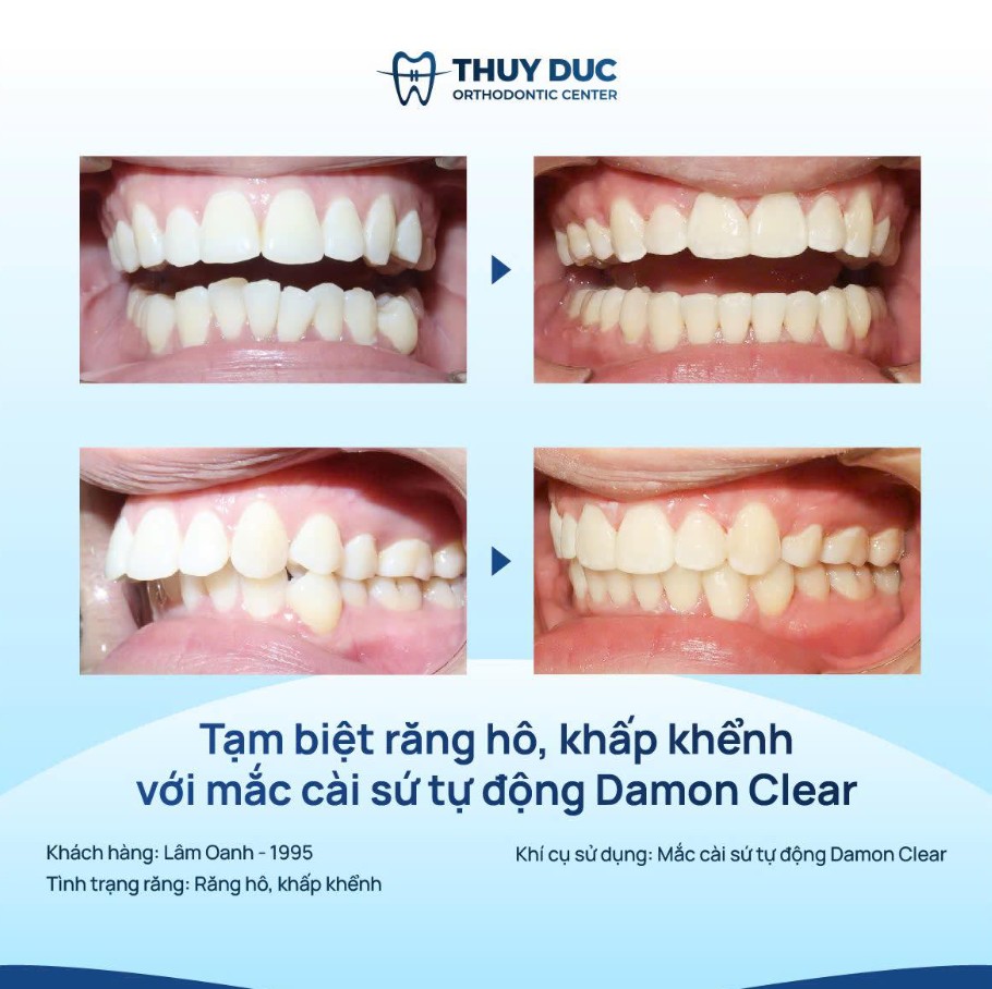 Niềng răng có hết hô không? 1