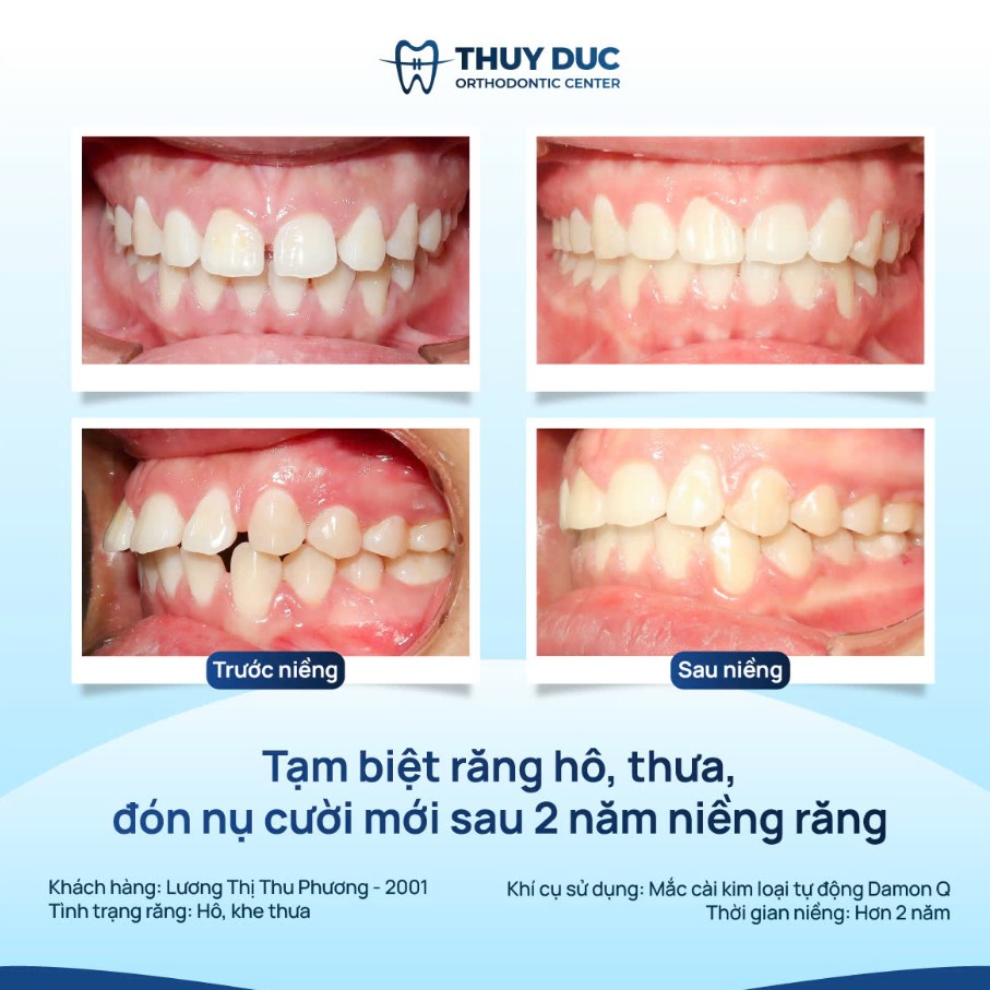 Các loại niềng răng hô 2