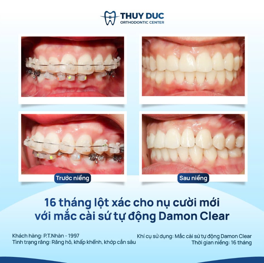 Các loại niềng răng hô 3