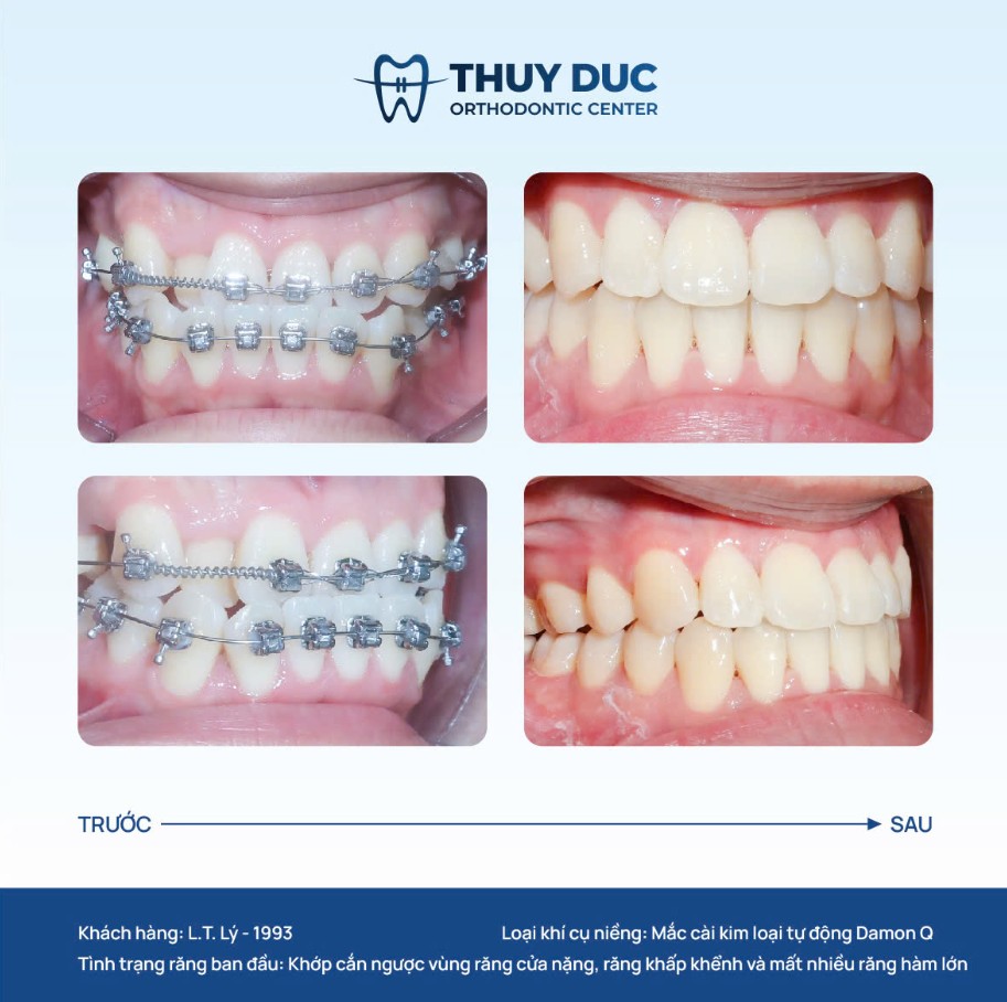 7. Hình ảnh thay đổi của một số ca niềng móm tại Thúy Đức 3