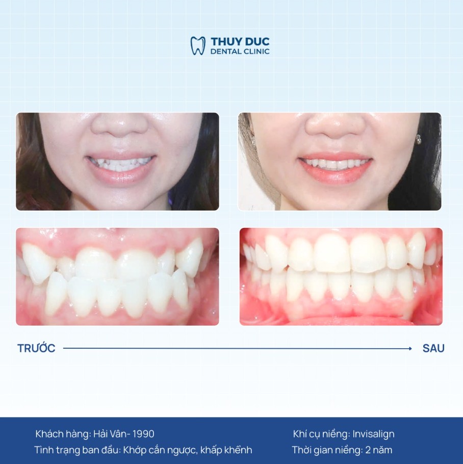 7. Hình ảnh thay đổi của một số ca niềng móm tại Thúy Đức 7 7. Hình ảnh thay đổi của một số ca niềng móm tại Thúy Đức 7