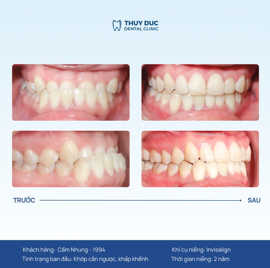 7. Hình ảnh thay đổi của một số ca niềng móm tại Thúy Đức 6