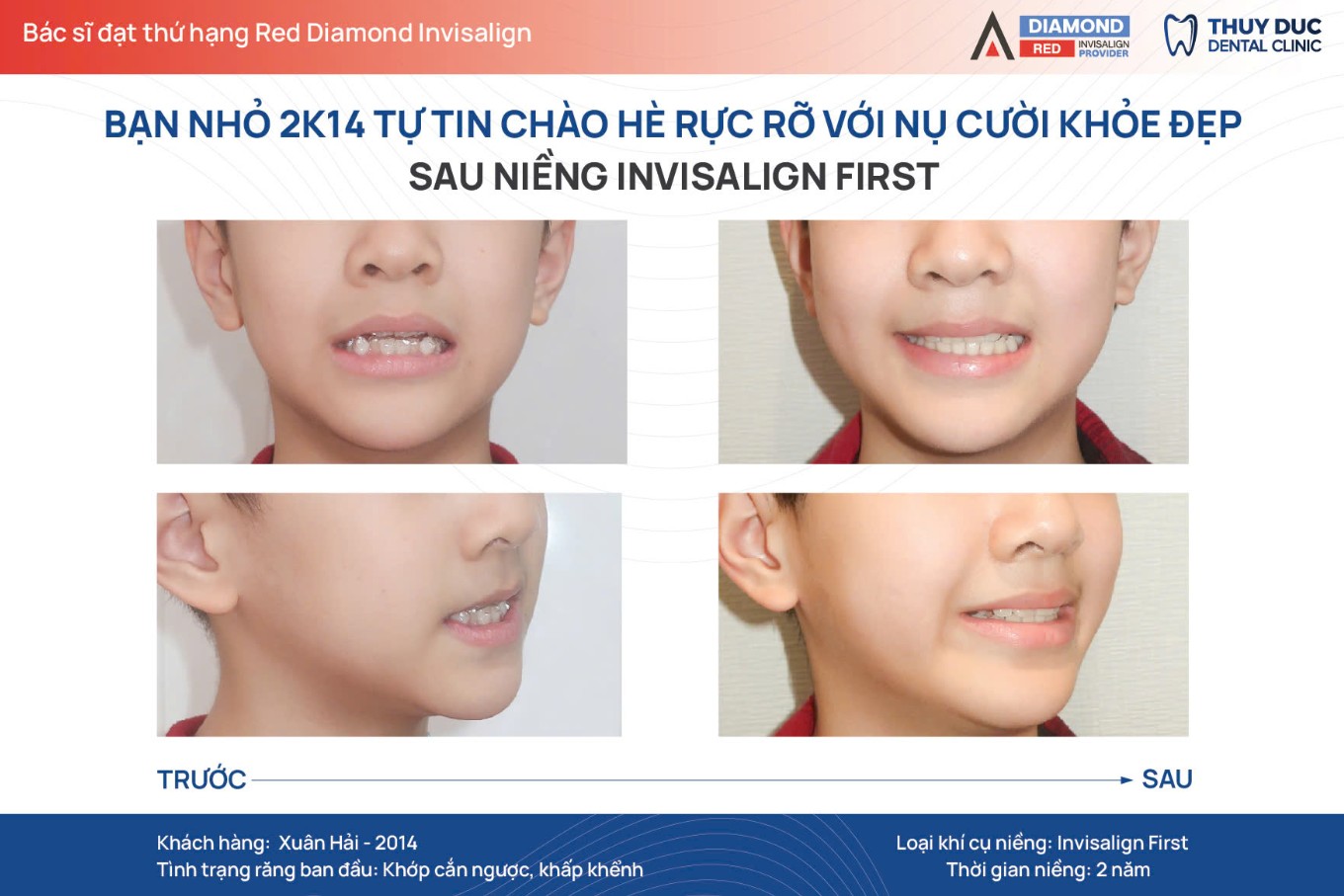 7. Hình ảnh thay đổi của một số ca niềng móm tại Thúy Đức 1