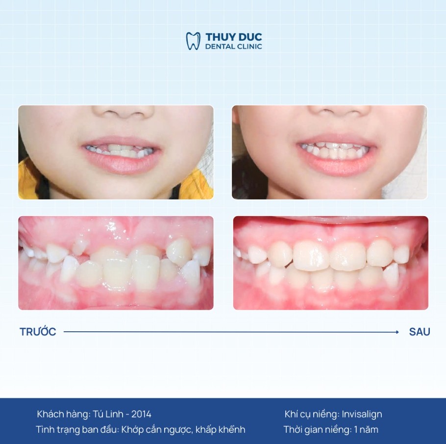 7. Hình ảnh thay đổi của một số ca niềng móm tại Thúy Đức 2 7. Hình ảnh thay đổi của một số ca niềng móm tại Thúy Đức 2