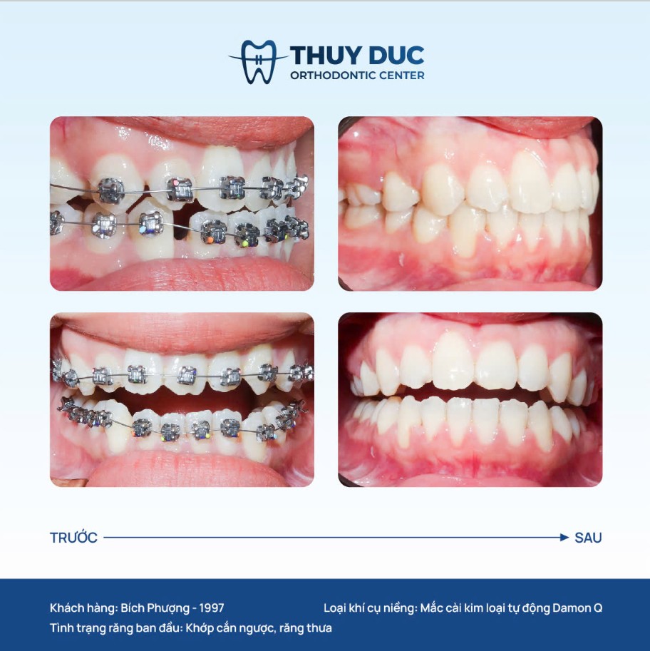 7. Hình ảnh thay đổi của một số ca niềng móm tại Thúy Đức 5 7. Hình ảnh thay đổi của một số ca niềng móm tại Thúy Đức 5