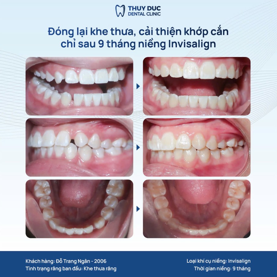 5. Hình ảnh một số ca niềng răng thưa tại nha khoa Thúy Đức 2
