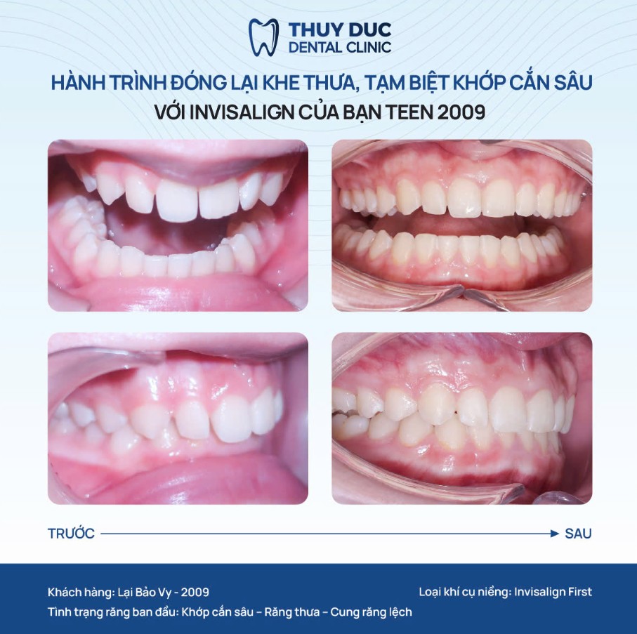 5. Hình ảnh một số ca niềng răng thưa tại nha khoa Thúy Đức 3