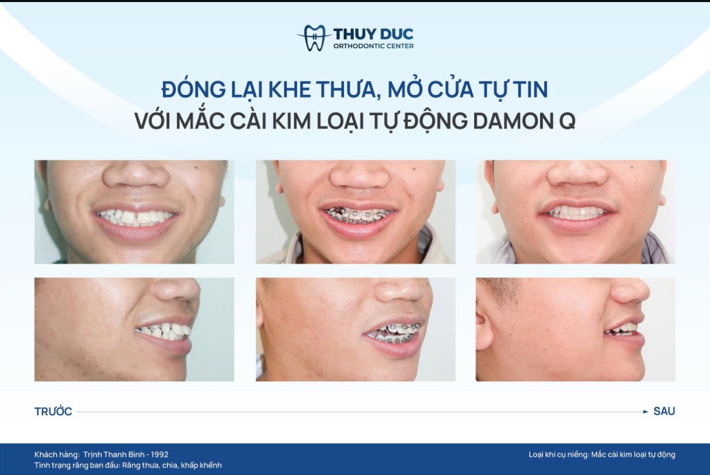2. Niềng răng thưa mang lại những lợi ích gì 1