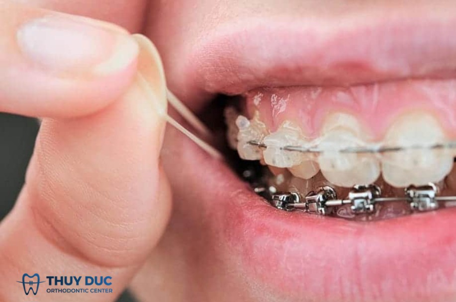 1. Hướng dẫn thay dây thun đúng cách tại nhà (nếu bác sĩ cho phép) 1 1. Hướng dẫn thay dây thun đúng cách tại nhà (nếu bác sĩ cho phép) 1