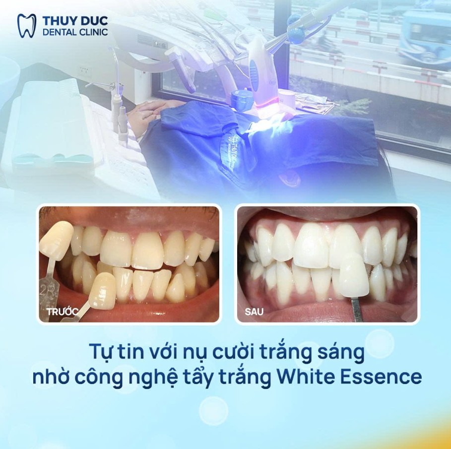 1. Tẩy trắng răng tại phòng nha 1